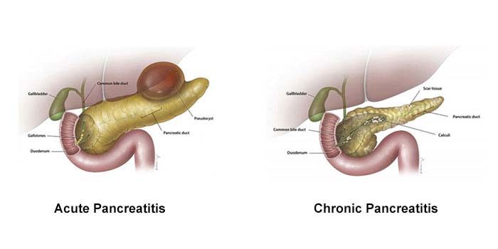 pancreatitis ( pancreas inflammation ) treatment in mumbai