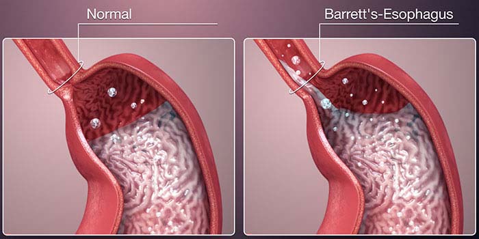 barrett's esophagus treatment in mumbai