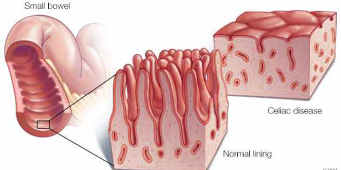 celiac disease (sprue) treatment in mumbai