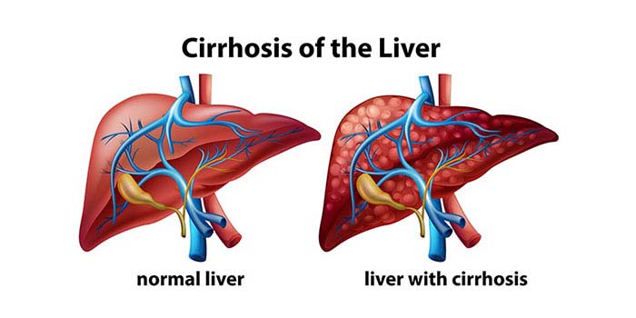 liver cirrhosis treatment in mumbai