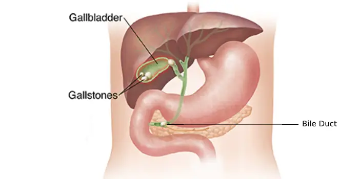 gallstones treatment in mumbai