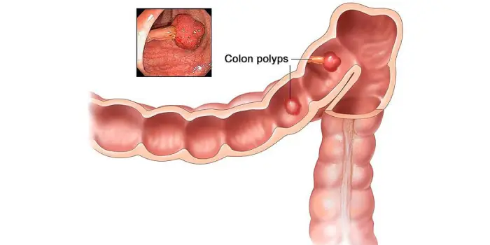 stomach cancer treatment in mumbai