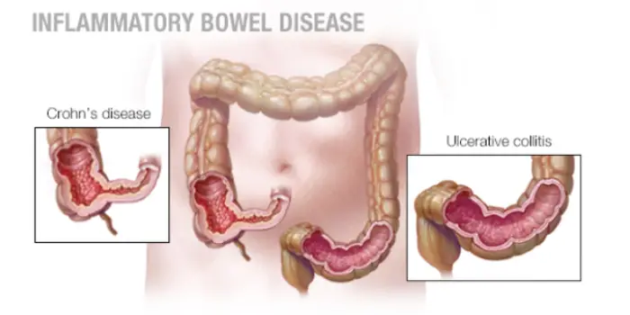 inflammatory bowel disease(ibd) treatment in mumbai