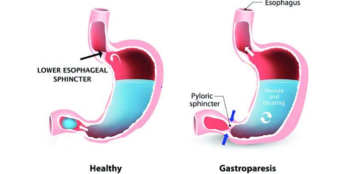 gastroparesis treatment in mumbai