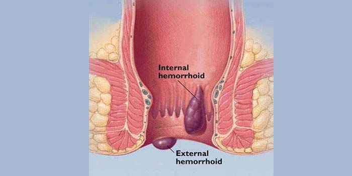 piles ( haemorrhoids ) and fissures treatment in mumbai