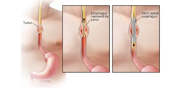 self-expandable metallic stent (sems) placement in mumbai