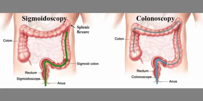 sigmoidoscopy & colonoscopy in mumbai