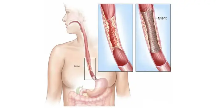 esophageal stricture dilation treatment in mumbai