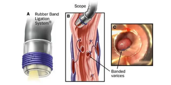 endoscopic variceal ligation in mumbai