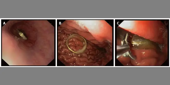 endoscopic foreign body removal in mumbai