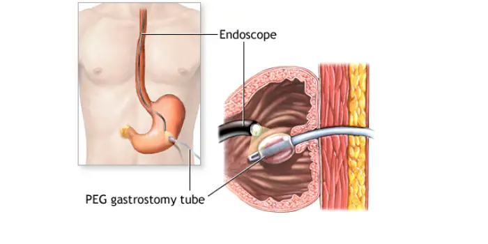 percutaneous endoscopic gastrostomy(peg) tube placement