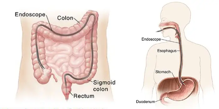 gastrointestinal endoscopy - upper gi and lower gi endoscopy in mumbai
